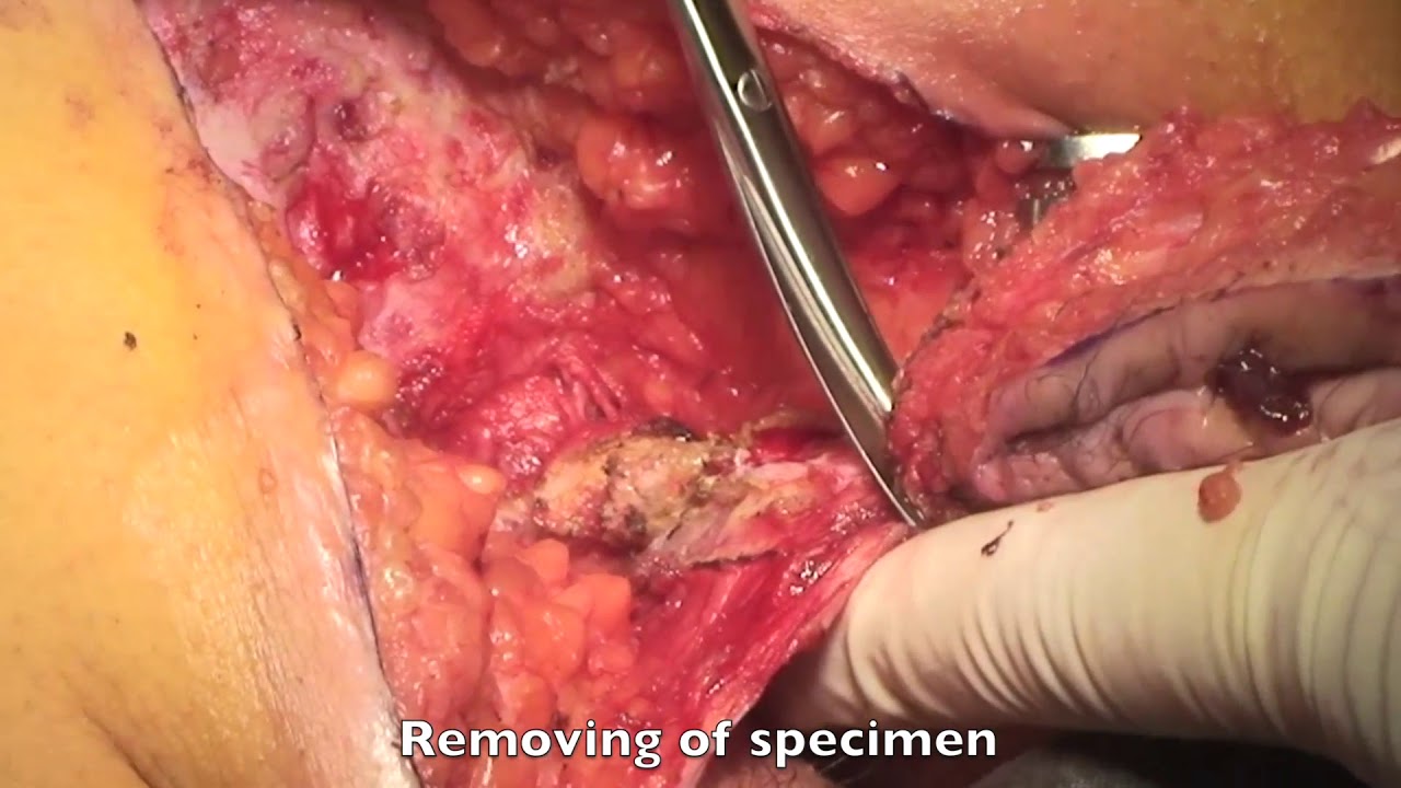 Excision of Extensive Recurrent Pilonidal Cyst with Gluteus Muscle Fascia Plasty & Mid-line Closure (720p)